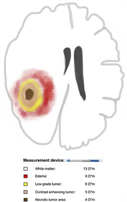 Mini Review: Impedance Measurement in Neuroscience and Its Prospective Application in the Field of Surgical Neurooncology